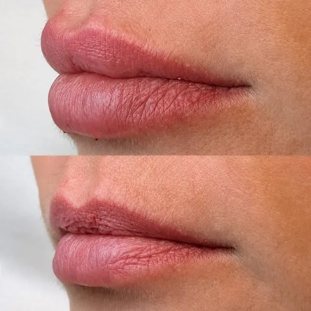 Lábios antes e depois da escultura labial
