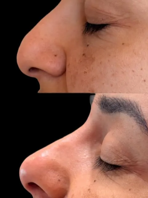 Perfil do nariz antes e depois