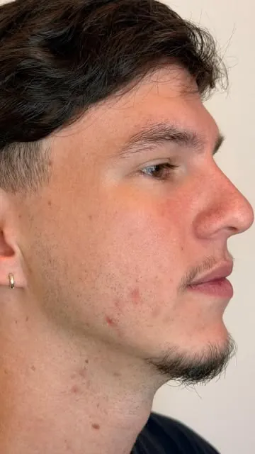 Perfil masculino após perfiloplastia