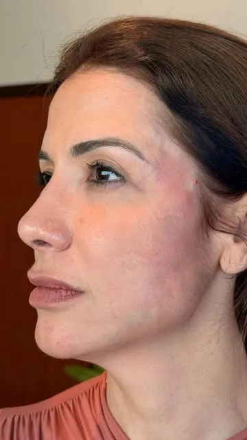 Perfil feminino com fios de PLLA